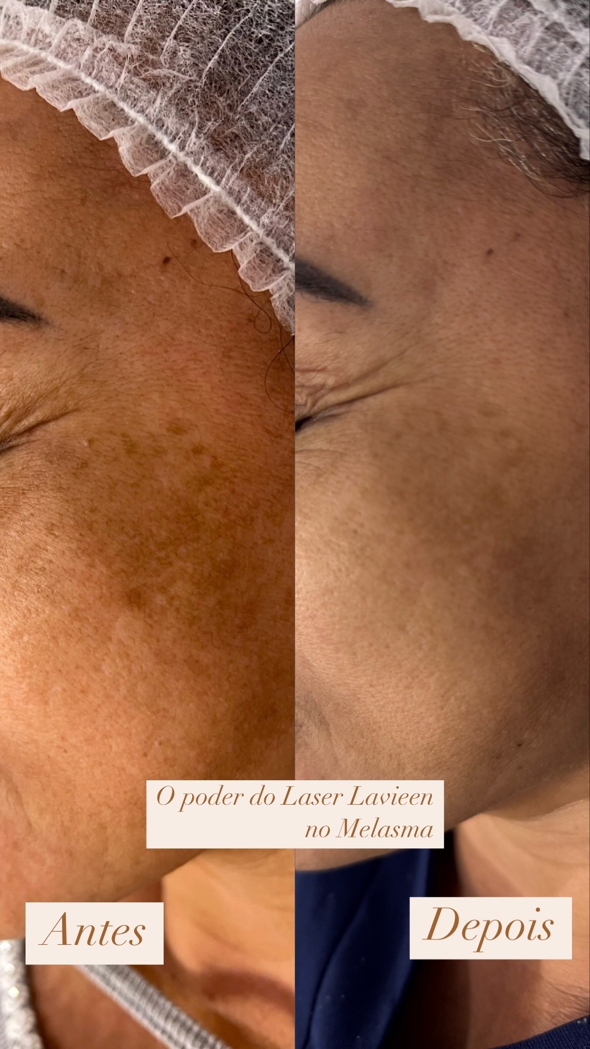 Antes e depois real do tratamento de melasma com Laser Lavieen, publicado por Simone Navarro